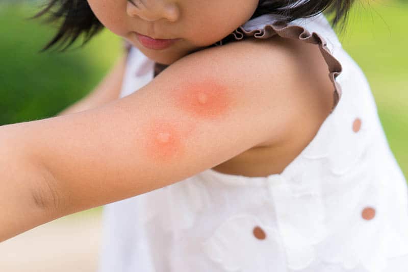 Mosquito Bites On Babies: The Best Ways To Manage The Menace