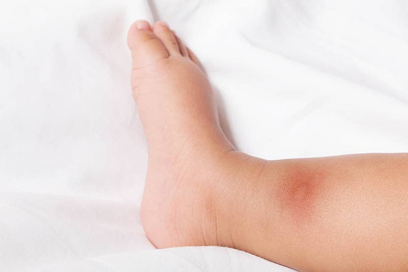 Mosquito Bites on babies foot