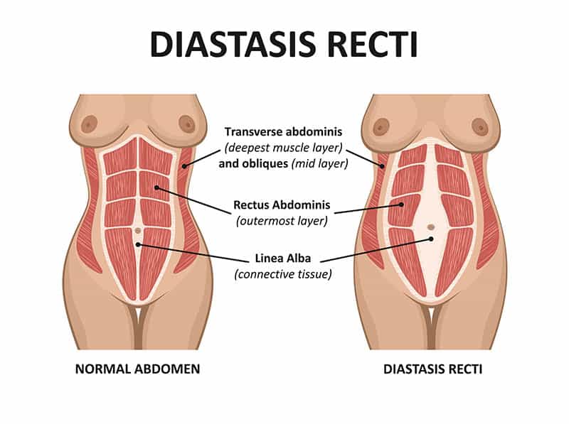 Diastasis recti. Abdominal muscle diastasis after pregnancy pregnancy and childbirth.