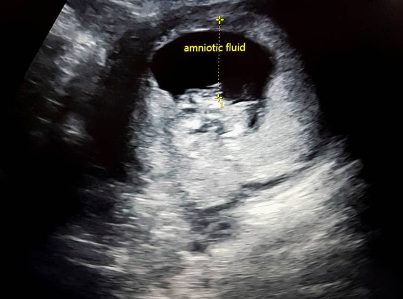 Ultrasound with fetus and amniotic fluid