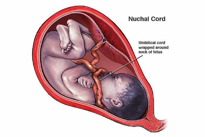 baby in distress nuchal cord