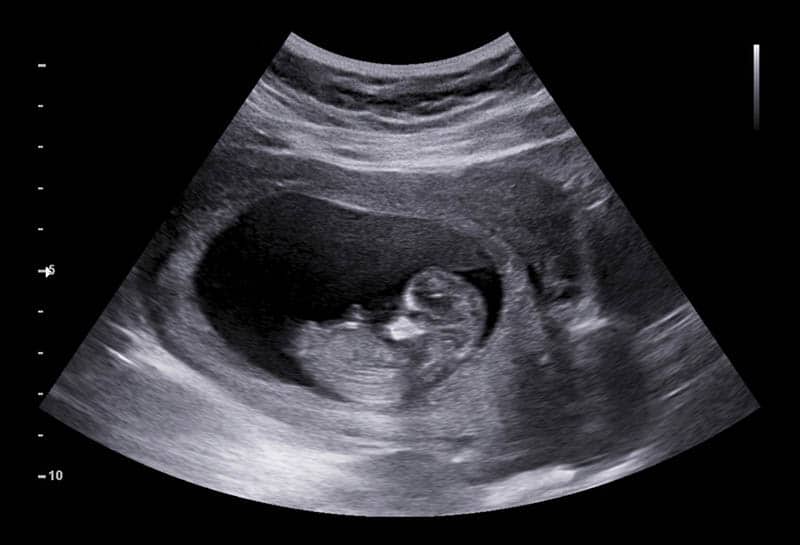 2d ultrasound of baby