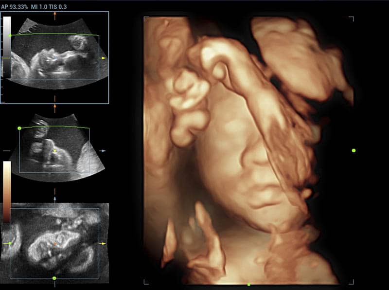 3d 4d ultrasound of baby in mother's womb