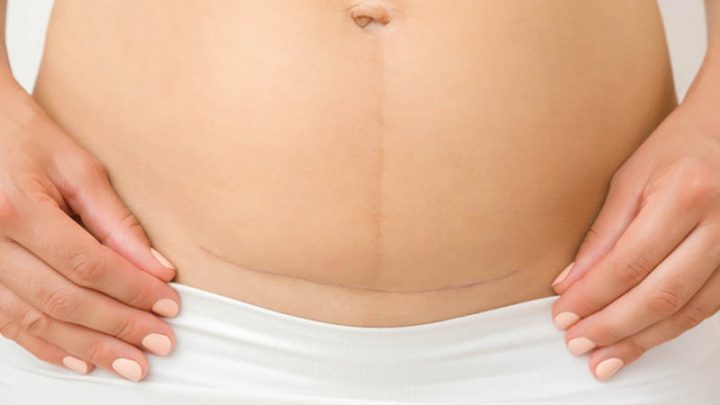 C-Section Scar Pain + 15 Other Potential Post-Cesarean Issues