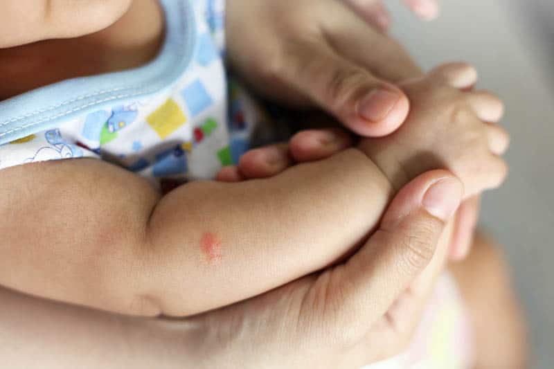 eczema on the babies hand