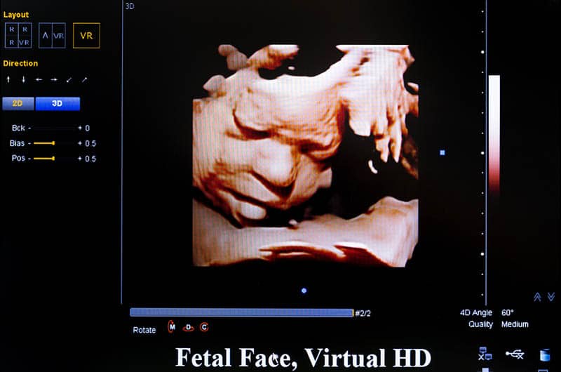 hd ultrasound of baby 