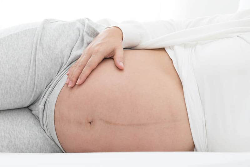 pregnant woman with linea nigra lying 