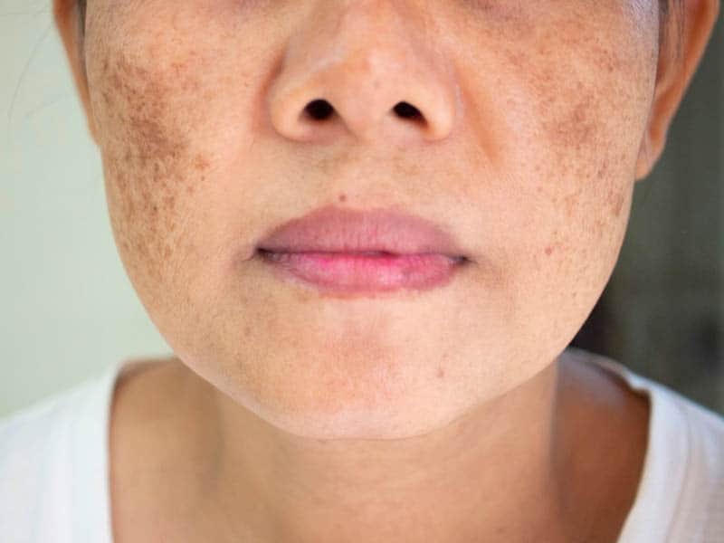 the dark spots on woman face