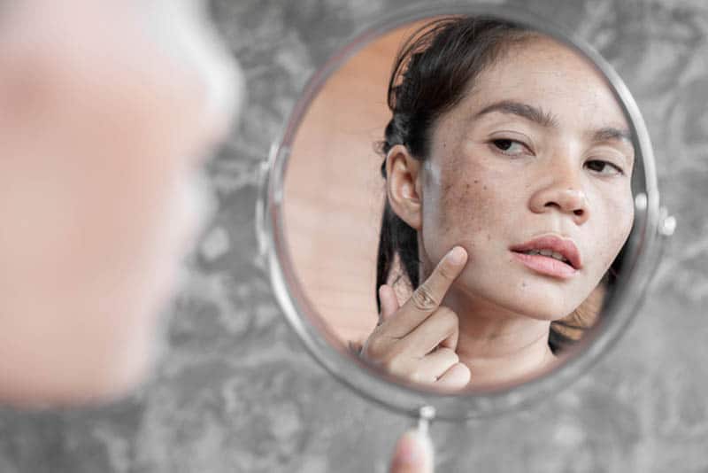 young woman checking melasma spots in the mirror