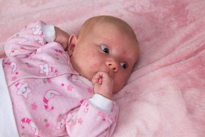 newborn girl with acne on her face lies on the crib